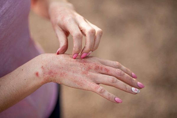 5 Cara Mengatasi Alergi pada Kulit Tangan Akibat Bahan Kimia