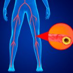10 Langkah Pencegahan Dini Penyakit Arteri Perifer
