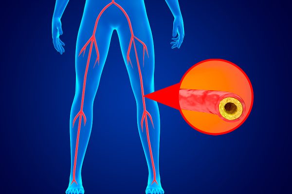 10 Langkah Pencegahan Dini Penyakit Arteri Perifer 10 Langkah Pencegahan Dini Penyakit Arteri Perifer
