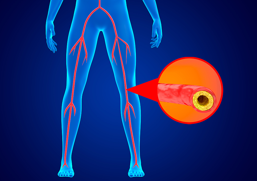 10 Langkah Pencegahan Dini Penyakit Arteri Perifer