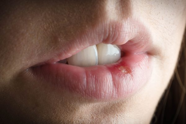 10 Cara Merawat Bibir agar Tidak Mudah Luka 10 Cara Merawat Bibir agar Tidak Mudah Luka