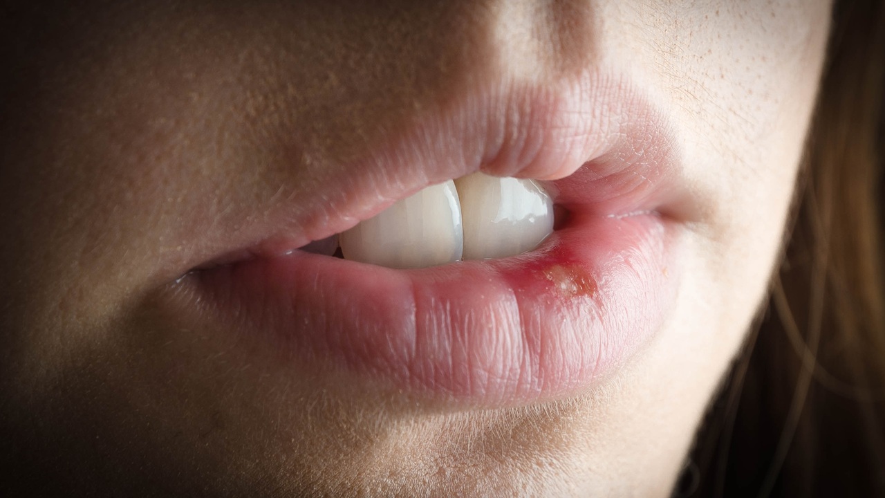 10 Cara Merawat Bibir agar Tidak Mudah Luka