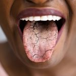7 Cara Sederhana Mencegah Lidah Kering