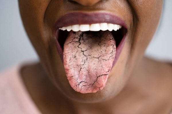 7 Cara Sederhana Mencegah Lidah Kering 7 Cara Sederhana Mencegah Lidah Kering