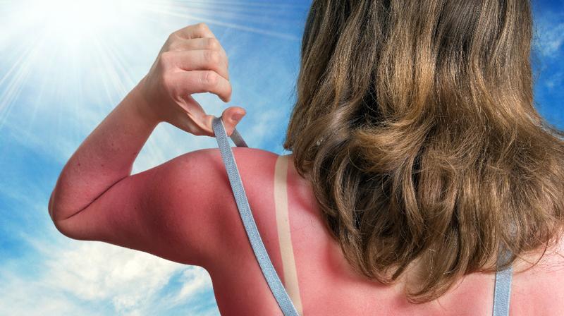 10 Cara Mengatasi Kulit yang Mudah Terbakar Matahari