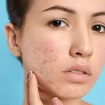 5 Cara Menghindari Bekas Jerawat di Dagu